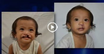 OB Cleft Lip Cleft Palate Reconstructive Surgery